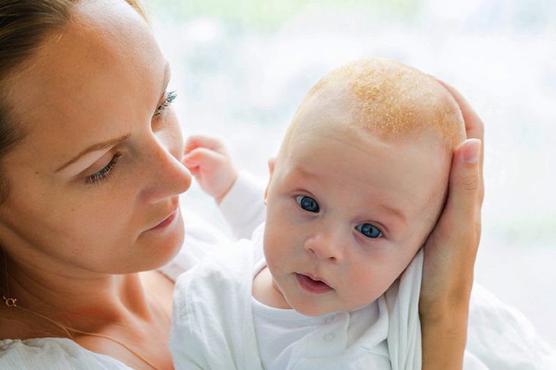Bebeklerde Konak Neden Olur? Nasıl Tedavi Edilir?, Konak nasıl temizlenir, konak şampuan